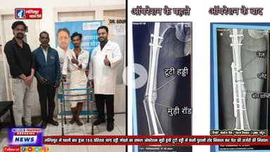 ललितपुर में पहली बार हुआ 100 प्रतिशत जल्द हड्डी जोडऩे का सफल ऑपरेशन जिसमें मुड़ी हुयी टूटी हड्डी