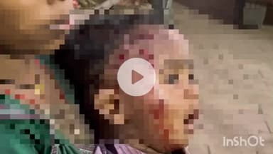 दुर्ग: ग्राम जंजगिरी में आवारा कुत्ते के आतंक से 2 साल का मासूम बच्चा गंभीर रूप से घायल