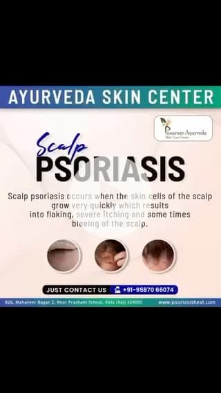Scalp psoriasis treatment in kota