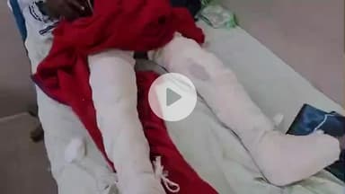 लाडपुरा: रेलवे कॉलोनी थाना क्षेत्र के भदाना में रुपयों के लेनदेन में युवक के पैर तोड़े, गंभीर घायल एमबीएस अस्पताल में भर्ती