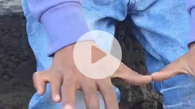 पंचकूला: गांव हरयोली में 9 साल के बच्चे के हाथ-पैरों में हैं 25 उंगलियां, चलने-लिखने में हो रही परेशानी