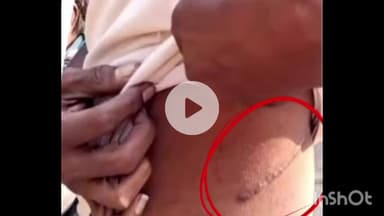 नागभिर: रोशन कुडे किडनी विक्री प्रकरणात त्या सहाही अवैद्य सावकाराचा जमानत अर्ज न्यायालयाने फेटाळला