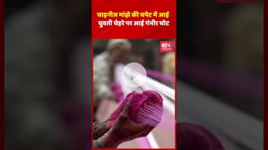 चाइनीज मांझे की चपेट में आई युवतीचेहरे पर आई गंभीर चोट  #kite #chhattisgarh #shorts