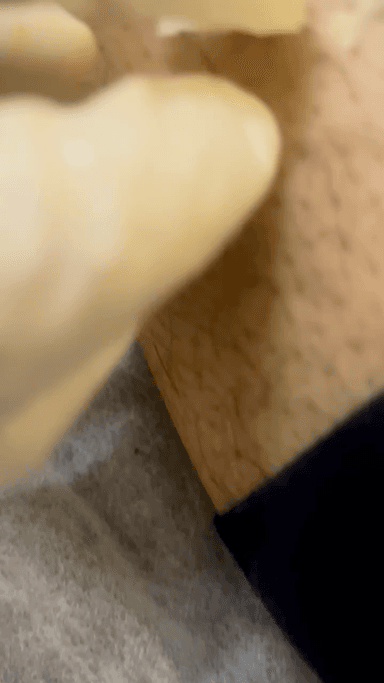 Leech therapy in kota