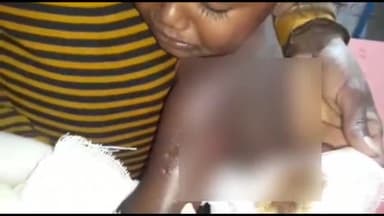 अररिया: हृदयपुर में पागल कुत्ते ने बच्चे को काटकर किया जख्मी इलाज के लिए सदर अस्पताल में भर्ती