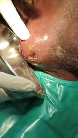 perapical infection,space infection #triveniganj #supaulbihar
