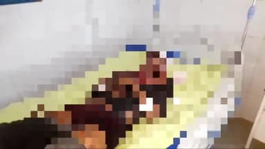 मुरादाबाद: भोजपुर में झगड़े के बाद CHC के डॉक्टर ने मरीज के नहीं लगाए टांके, हायर सेंटर के डॉक्टर ने लगाया लापरवाही का आरोप