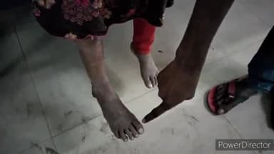 कटिहार: संदलपुर में खेत के समीप खेल रही किशोरी को जहरीले सांप ने काटा, सदर अस्पताल में कराया गया भर्ती