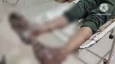 फिरोज़ाबाद: नगला कान्हा में फसल में लगी आग बुझाते समय झुलसे युवक के दोनों पैर, लाया गया जिला अस्पताल