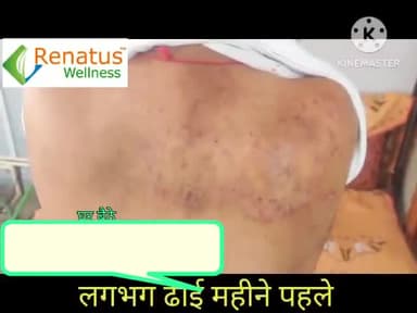 स्किन की समस्या में मिला शानदार रिजल्ट रिनेटस नोवा के इस्तेमाल से आइए सुनते हैं खुद इनकी जुबानी...8077642441