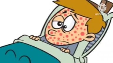 करेली: करेली अंतर्गत हनुमान वार्ड में मिले चिकन पॉक्स के 3 नए मरीज़