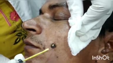 आरा: कर्मन टोला में विश्वराज हॉस्पिटल में लेजर द्वारा बाल व स्किन ट्रीटमेंट,गंजेपन सफेद दाग, काले दाग से छुटकारा, 9572221889