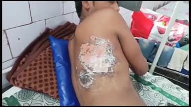 पन्ना: बराछ में विधुत खंबे में काम करते समय 30 वर्षीय लाइनमैन को लगा करंट गंभीर घायल जिला अस्पताल मे कराया भर्ती।