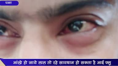 पन्ना: जिले में आई फ्लू के मरीजों की बढ़ती संख्या को देखते हुए CMHO ने बताए बचाव के उपाय