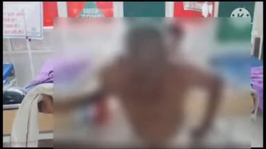 फिरोज़ाबाद: निहालपुर में ट्रांसफार्मर फटने से झुलसा व्यक्ति, अस्पताल में कराया गया उपचार