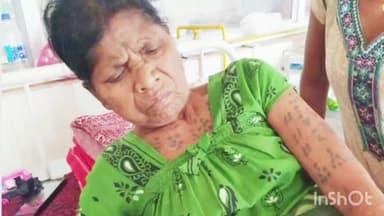 जगदलपुर: मेकॉज में हुआ 60 वर्षीय बुजुर्ग महिला के घुटने का सफल ट्रांसप्लांट