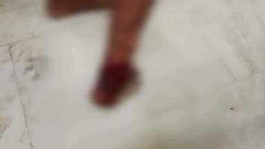 गुमला: सरनाटोली व ढोढरी टोली में पागल कुत्ते ने दो लोगों को काटा, लाया गया सदर अस्पताल