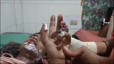 इकौना: कस्बा इकौना भिंगा रोड साई मंदिर के पास आतिशबाजी करते समय हाथ में फटा गोला, 8 वर्षीय बालक हुआ घायल