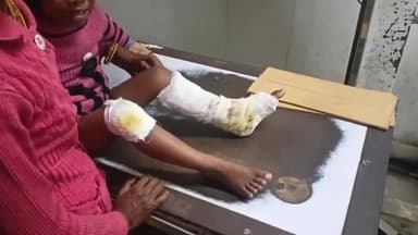 पडरौना: बरियापुर गाँव में दरवाजे पर खड़ी मासूम बच्ची को बाइक सवार युवक ने मारी टक्कर, हादसे में बच्ची के दोनों पैर टूटे