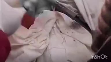 कानपुर: विजयनगर में बस और लोडर की टक्कर में घायल बुजुर्ग का सफल ऑपरेशन,सीने को पार कर गई थी लोहे की रॉड