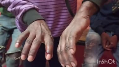 अजयगढ़: अजयगढ में जंगली सियार के हमले में 40 वर्षीय व्यक्ति घायल अस्पताल में भर्ती