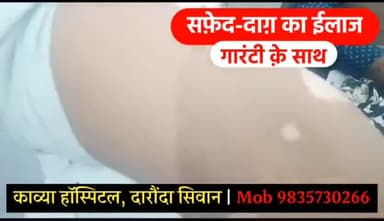 आरा: सिवान जिले के काव्या हॉस्पिटल में सफ़ेद-दाग का गारंटी के साथ हो रहा है ईलाज, दवा का फायदा नहीं तो पैसा वापस.M-9835730266