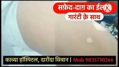 बक्सर: सिवान जिले के काव्या हॉस्पिटल में सफेद दाग का गारंटी के साथ हो रहा है इलाज,दवा का असर नहीं तो पैसा वापस।Mob -9835730266