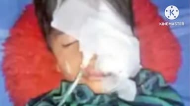 हुज़ूर: भोपाल में आवारा कुत्तों के हमले से घायल 6 वर्षीय बच्चे के जबड़े में आए 20 टांके, लोगों ने कुत्ते को पीट-पीटकर मार डाला