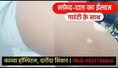 अररिया: सिवान जिले के काव्या हॉस्पिटल में सफेद दाग का गारंटी के साथ हो रहा है इलाज, दवा का असर नहीं तो पैसा वापस |