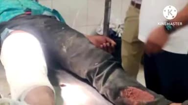 पचपदरा: पिकअप एवं बाइक की भिड़ंत में गंभीर घायल युवक को बालोतरा से जोधपुर किया गया रेफर