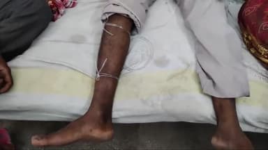 अररिया: पटेगना मे घर के बाहर टहलने के दौरान एक व्यक्ति को सांप ने डशा इलाज के लिए सदर अस्पताल में भर्ती