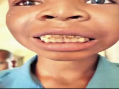 कोंडागांव: कोंडागांव जिले के 28 गांवों के पानी में सामान्य से दोगुना फ्लोराइड के इस्तेमाल से गिर रहे दांत