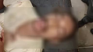 सुल्तानपुर: लोदीपुर अहिमाने में आपसी विवाद में एक युवक ने दांत से काटा दूसरे युवक का होंठ,चल रहा इलाज