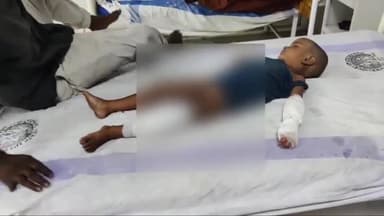 पलासी: हसनपुर में खेलने के दौरान गर्म पानी में गिर जाने से बालक झुलसकर हुआ घायल इलाज जारी