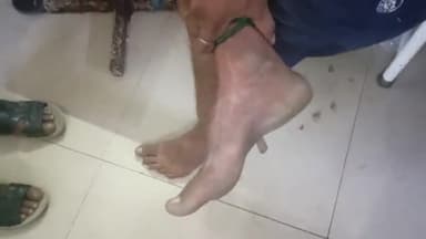 हाथरस: कस्बा सहपऊ में घर के बाहर एक युवक को सांप ने पैर पर काटा, हालत बिगड़ने पर एंबुलेंस से कराया गया जिला अस्पताल में भर्ती