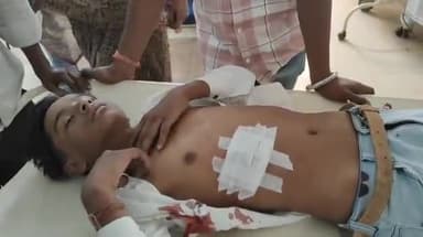 शिवपुरी नगर: शांति नगर में डिब्बे में रखकर पटाखे जला रहा था पड़ोसी का लड़का; चपेट में आकर घायल हुआ किशोर, पेट में आए टाँके