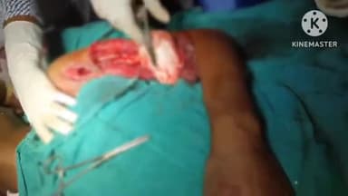 लोहरदगा: कैमो स्कूल के पास शंख मोड़ चांपी रोड पर ट्रक और मोटरसाइकिल की टक्कर, तीन लोग घायल