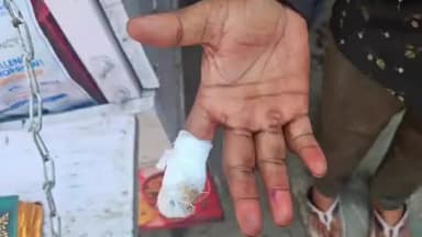 कानपुर: बड़े चौराहे पर सवारी बैठाने को लेकर विवाद में ओला कार चालक ने ऑटो चालक की उंगली को दांत से चबा डाला