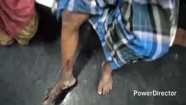 कटिहार: सिंघिया में तालाब में मछली पकड़ते समय व्यक्ति को जहरीले सांप ने डंसा, इलाज के लिए भर्ती, परिजन चिंतित