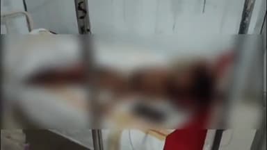 रामपुर के झांझर गांव में संदिग्ध परिस्थितियों में आग से झुलसा बालक, सतना जिला अस्पताल में भर्ती