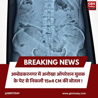 अम्बेडकरनगर: डॉक्टर का कमाल, युवक के पेट से निकाली प्लास्टिक की बोतल।
#AmbedkarNagar #MedicalMarvel #MiracleSurgery