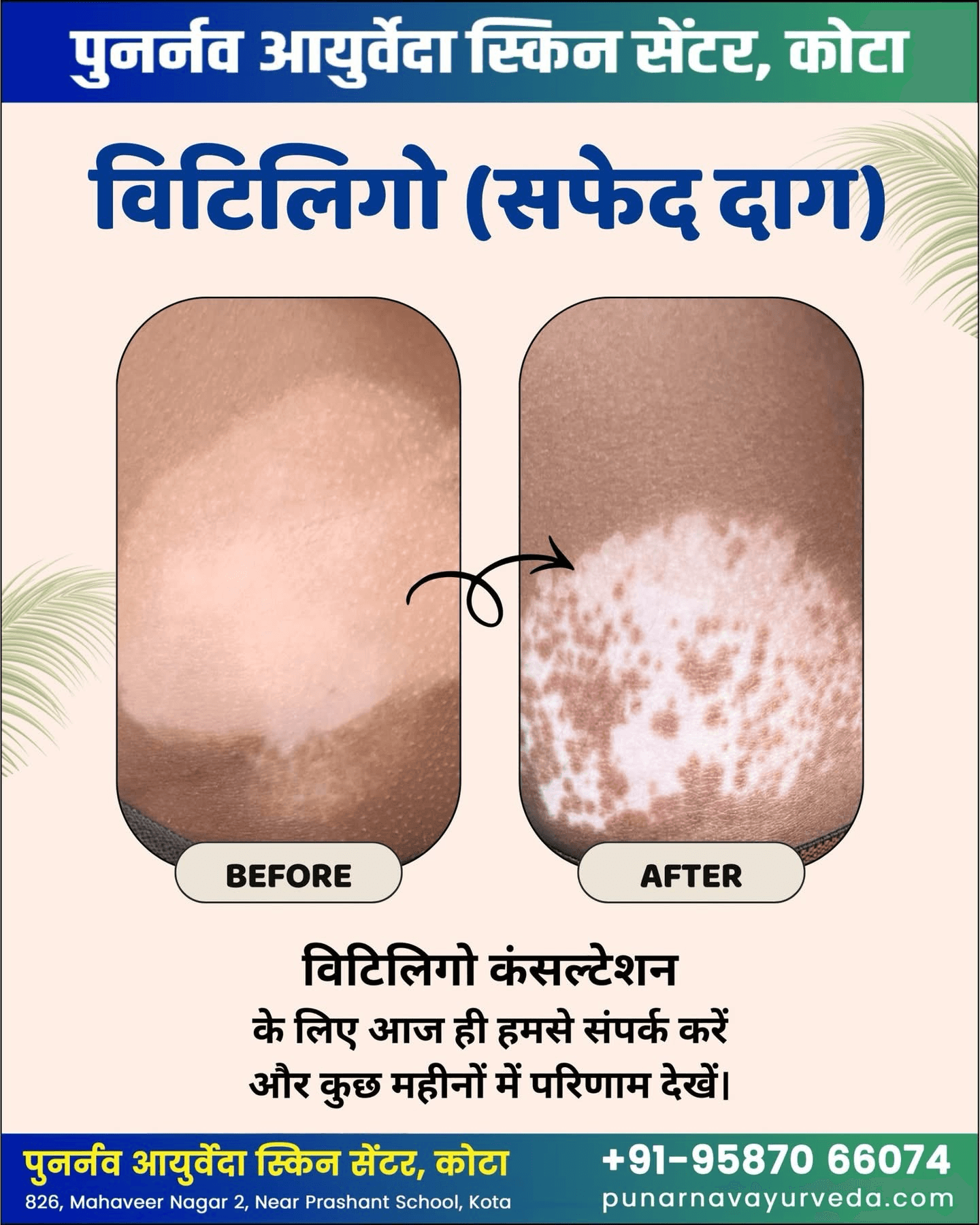 Punarnav ayurveda panchkarma and skin carw hospital kota treating white spot by ayurvedin kota