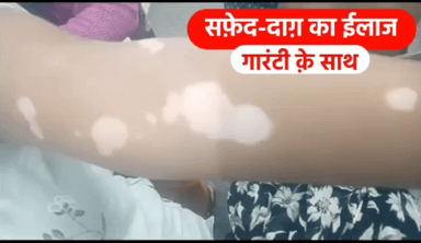 बिहार: सिवान जिले के काव्या हॉस्पिटल में सफेद दाग का गारंटी के साथ हो रहा है इलाज, दवा का असर नहीं तो पैसा वापस | Mob - 9835730266