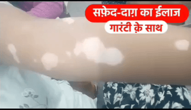 पूर्णिया पूर्व: सिवान जिले के काव्या हॉस्पिटल में सफेद दाग का गारंटी के साथ हो रहा है इलाज, दवा का असर नहीं तो पैसा वापस | Mob - 9835730266