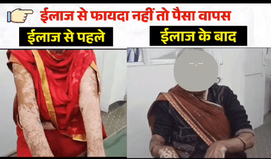 गोपालगंज: सिवान जिले के काव्या दवाखाना में वैध जी के द्वारा सफेद दाग का किया जा रहा है सफल इलाज, दवा का असर नहीं तो पैसा वापस | 9835730266