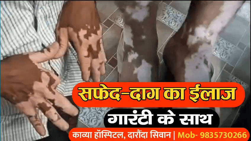 कोडरमा: सिवान जिले के काव्या सेवा सदन में सफेद दाग का गारंटी के साथ हो रहा है ईलाज, दवा का असर नहीं तो पैसा वापस | 9835730266