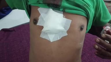 बांधवगढ़: ग्राम छादा में सनकी युवक ने शिवकुमार के सीने पर चाकू से किया हमला, गंभीर हालत में शहडोल रेफर