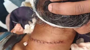 संग्रामपूर: नायलॉन मांजाने युवकाचा गळा चिरला..