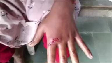 पतना: पतना में कुत्ते के काटने से दो बच्चे हुए घायल