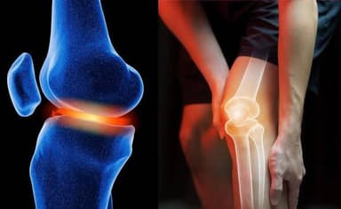 🦵 क्या आपके घुटनों में तेज दर्द, सूजन या चलने में परेशानी है?
क्या डॉक्टर ने Knee Replacement की सलाह दी है?
👉 घबराइए न...